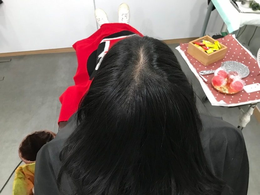 1차 레이저 시술 후 14일 뒤(보강 전)