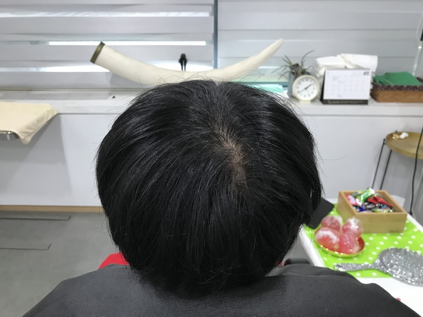 시술전