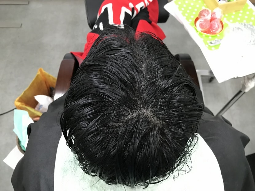 시술후