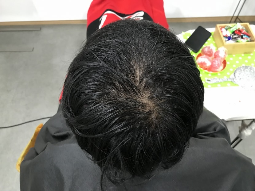 시술전