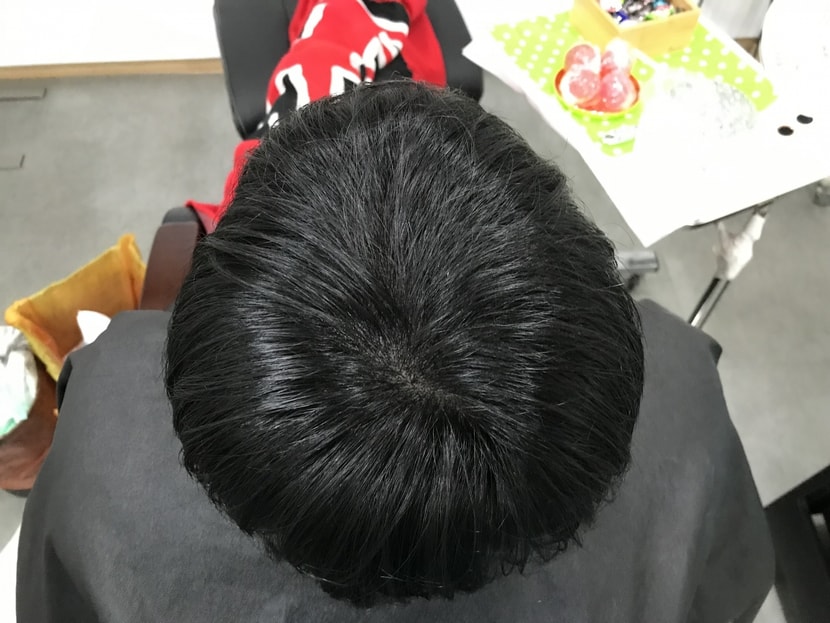 시술후