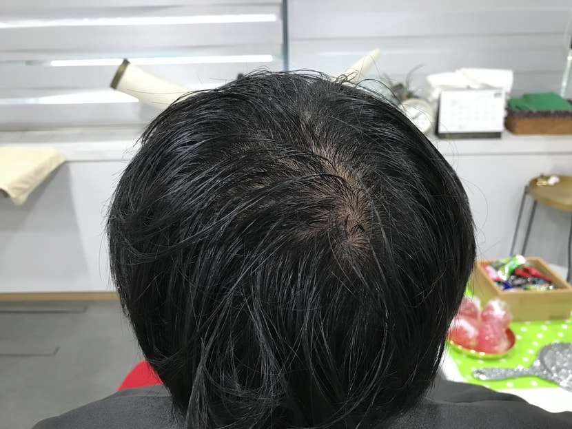 시술전