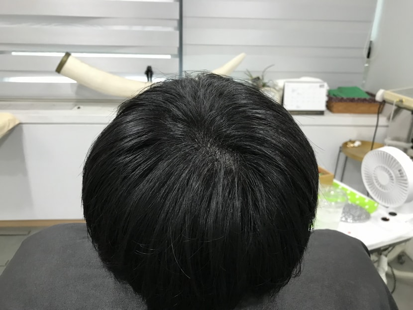 시술후