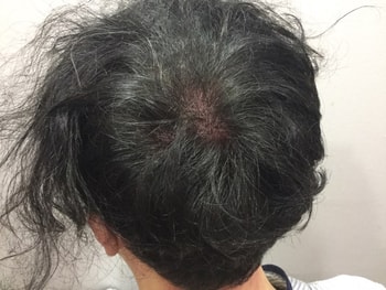 두피 문신 후 정수리2