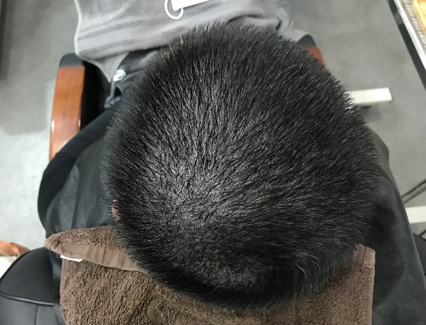수지침미세도트 시술직후