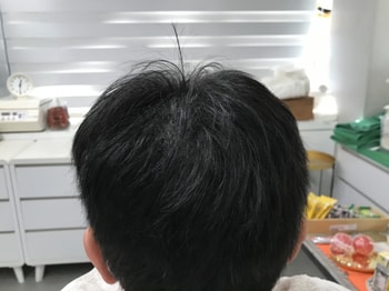 리터치 후 정수리