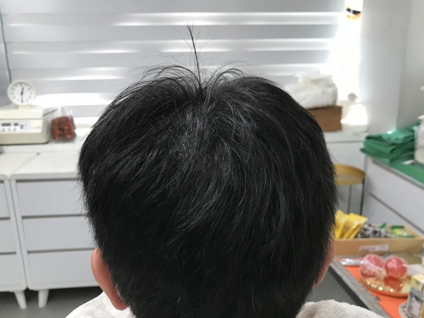 리터치 후 정수리