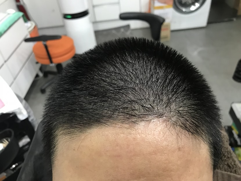 수지침미세도트 시술직후