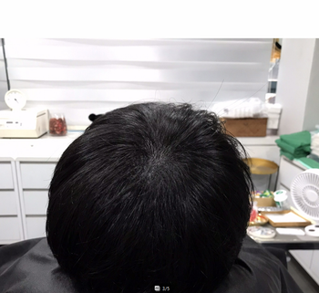 시술 후