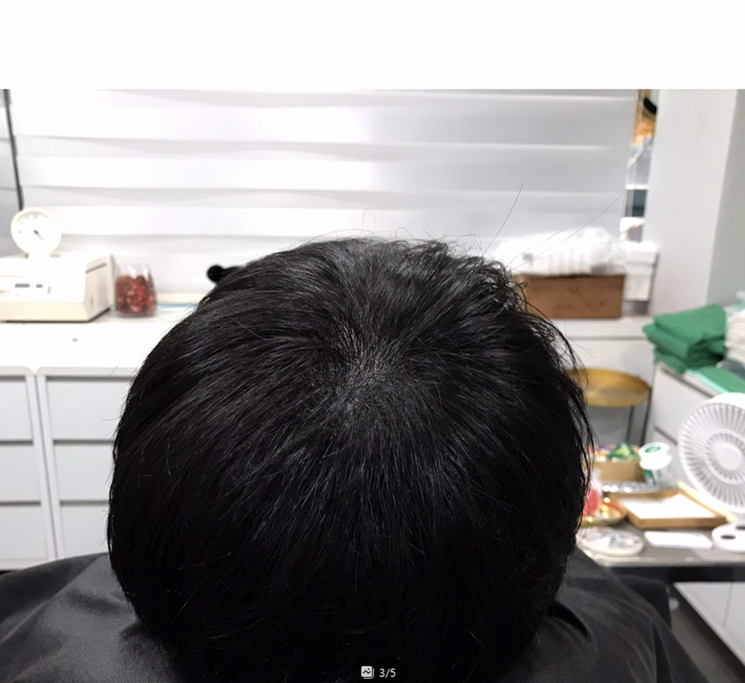 시술 후