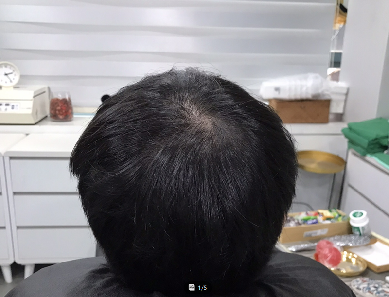 [Yonsei Midain Clinic]Yonsei Midain Clinic纹身头皮 4年后期