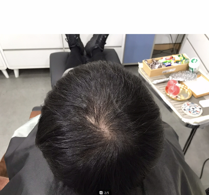 시술전