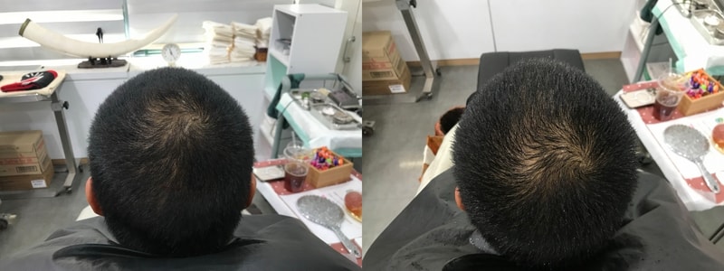 头皮纹身后期