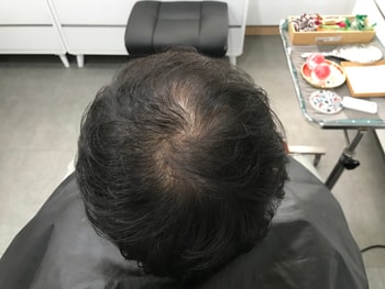 시술전