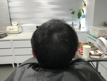 시술후