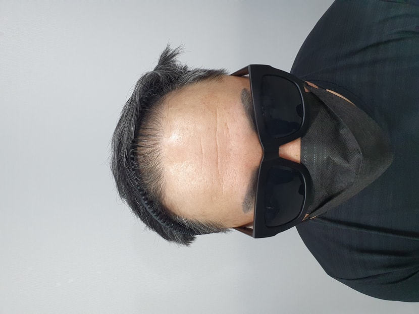 시술전