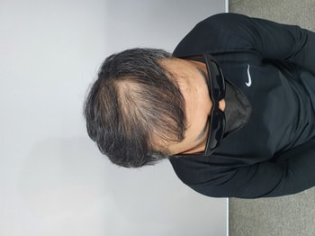 시술전