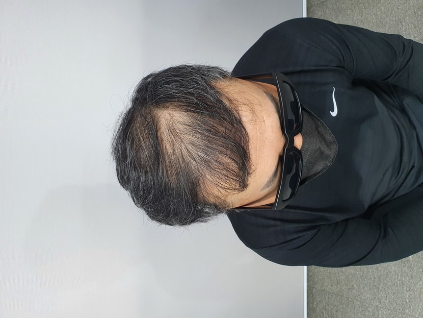시술전