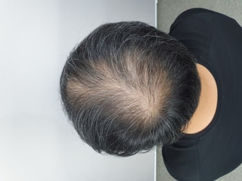 시술전