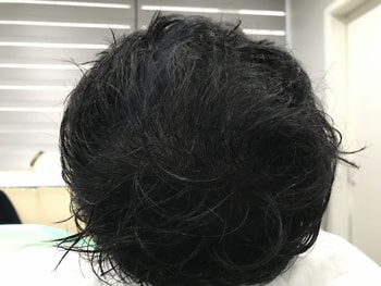 &lt;시술 후 젖었을 때&gt;