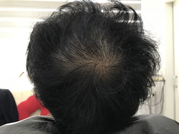 &lt;시술 전 말랐을 때&gt;
