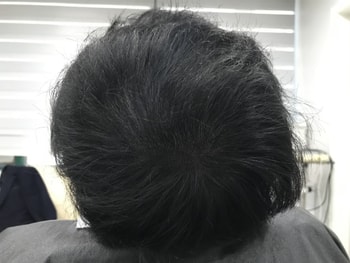 &lt;시술 후 말랐을 때&gt;