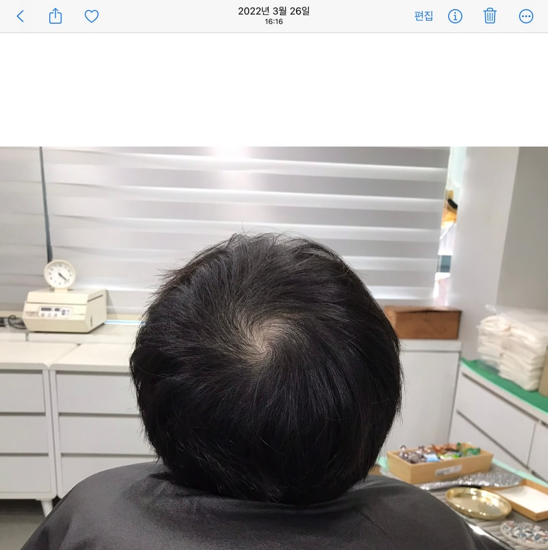 [Yonsei Midain Clinic] 纹头皮5年后记