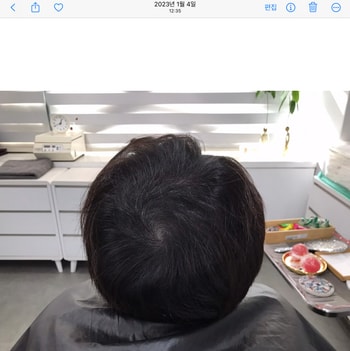 (시술 후)