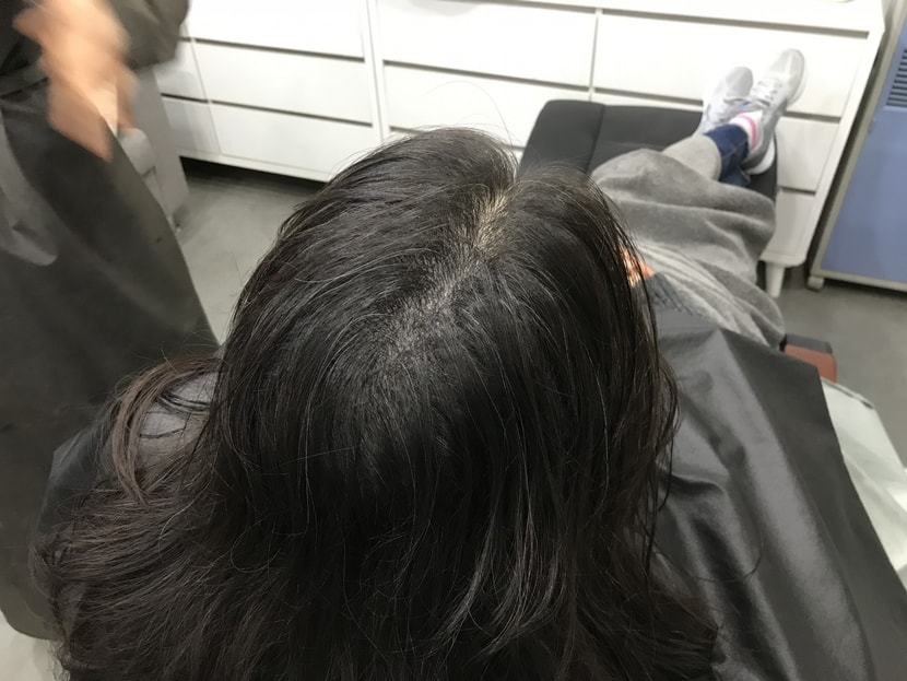 시술후 마른 상태