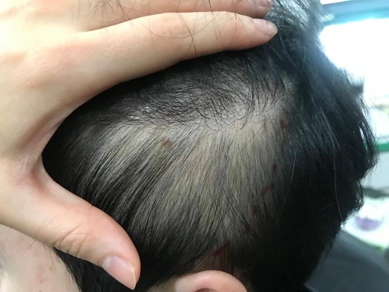 Review of scalp tattooing on the side hair