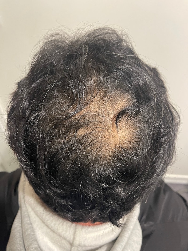 뉴헤어 정수리 두피문신