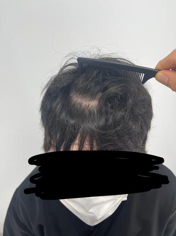 시술전