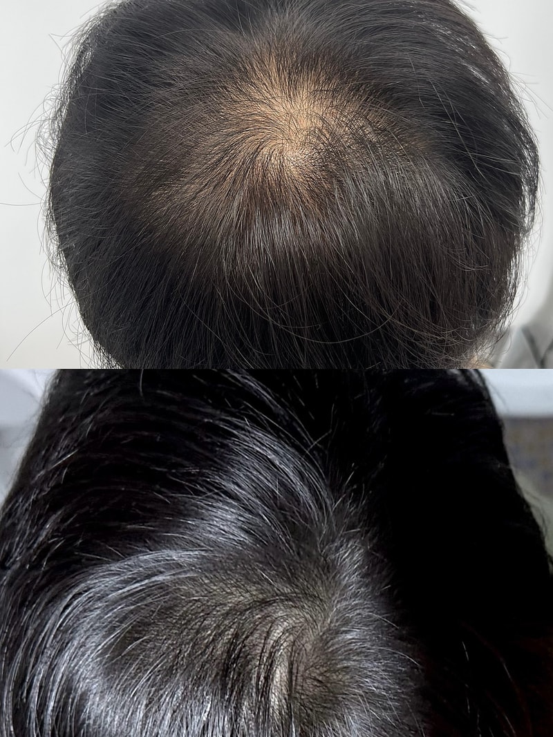 ニューヘアSMP頭頂頭皮タトゥー後記