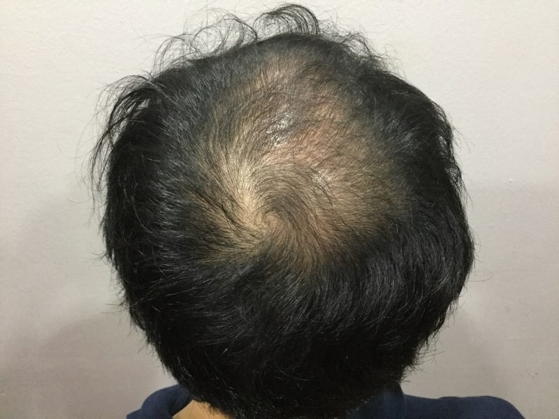 Revolutionary Medical Ideas Gangnam (Cheongdam) Review of Mikelan Clinic's scalp tattoo