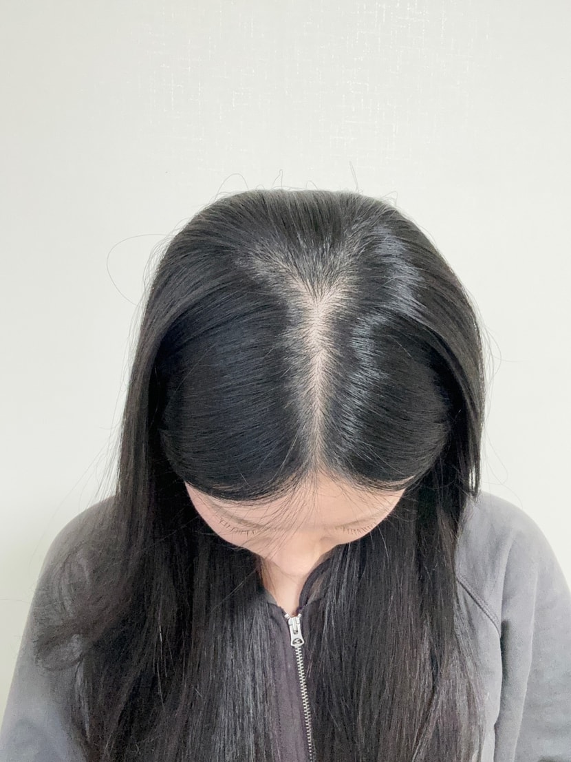 시술 전