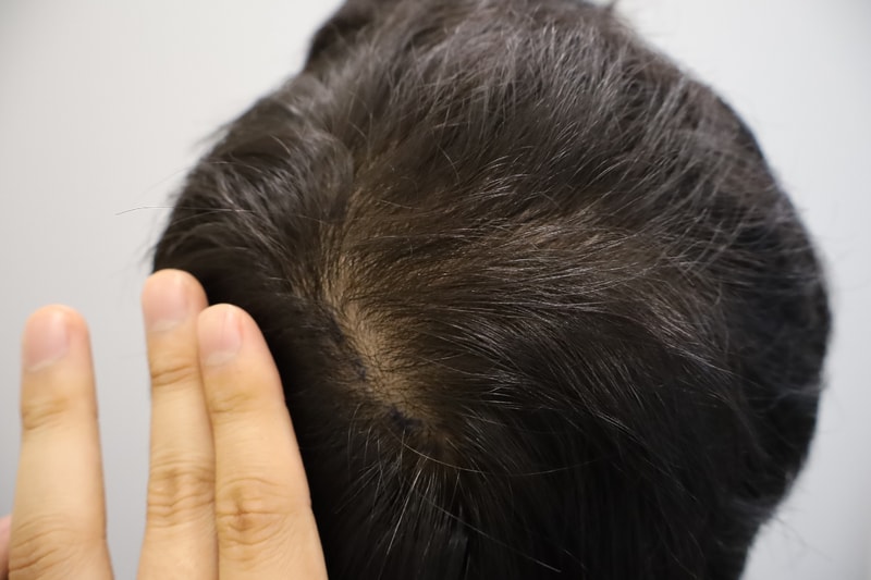 The 2nd Review of the Top of the Head scalp tattoo at Mowon Plastic Surgery Clinic