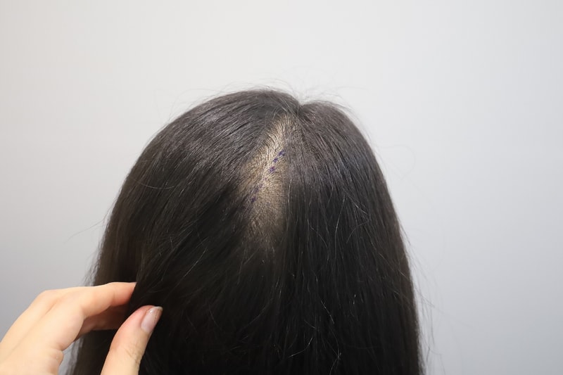 모원성형외과 (정재홍원장님) 가르마 정수리 두피문신 2차 후기