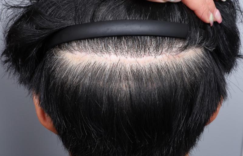 Review of Mo Won Plastic Surgery Director Jeong Jae-hong's scalp tattoo (cut scar + part + repair)
