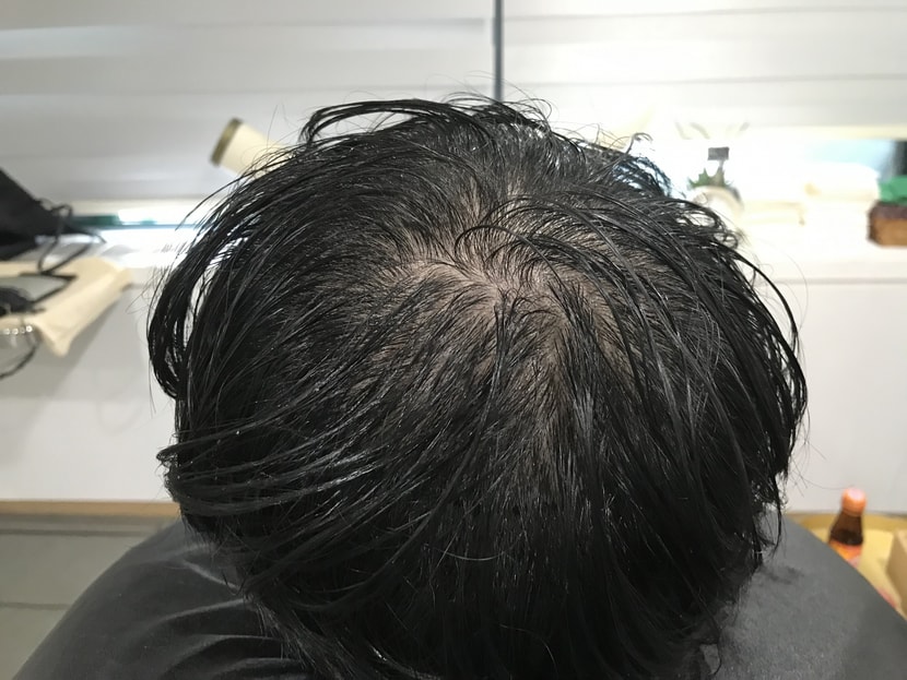 시술 전 젖은 머리