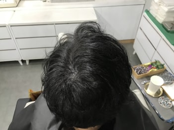 시술 직후 뒷모습