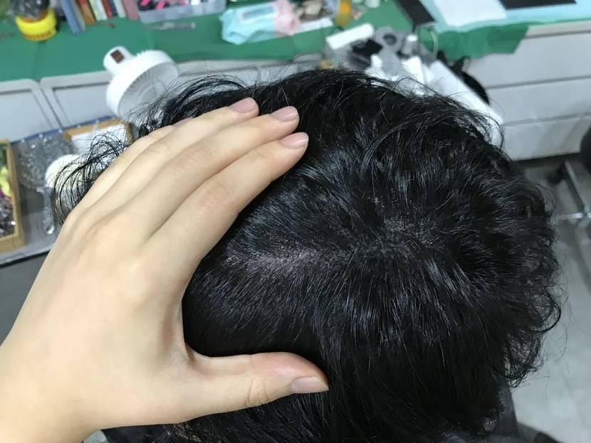 시술 직후 가르마