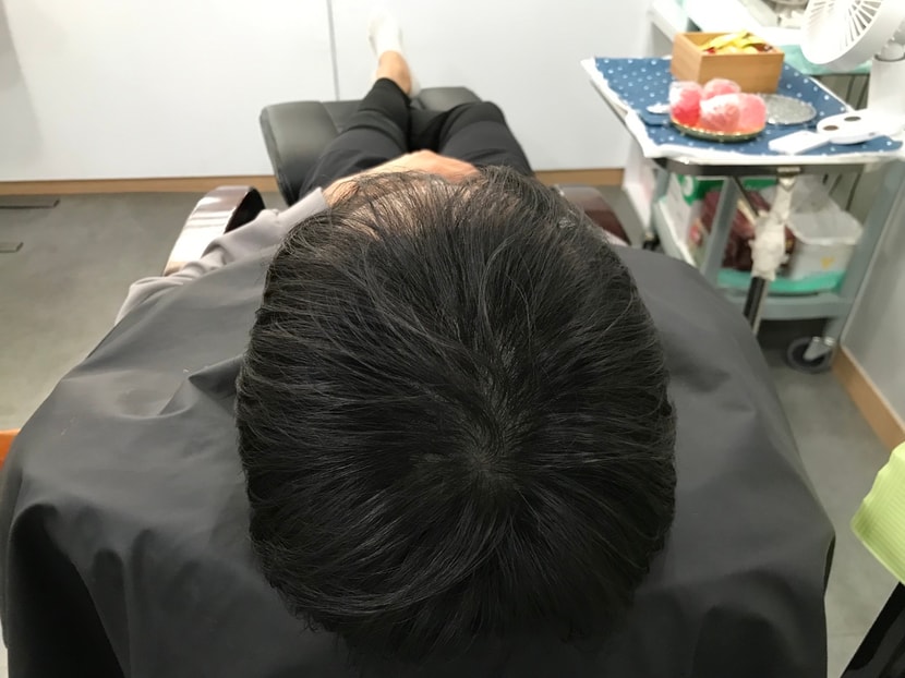 두피문신 2차보강 후 말린모습 