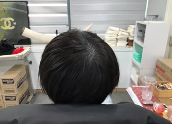 3년이 지난 2025년 10월, 많이 옅어졌습니다