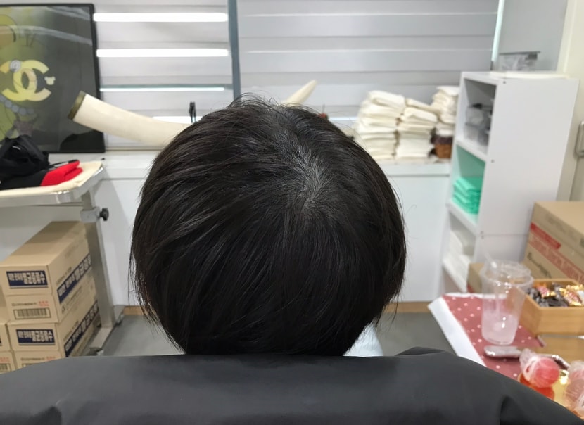 3년이 지난 2025년 10월, 많이 옅어졌습니다