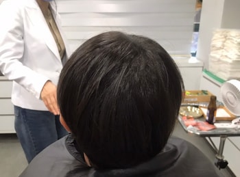 1차 시술 후 입니다.