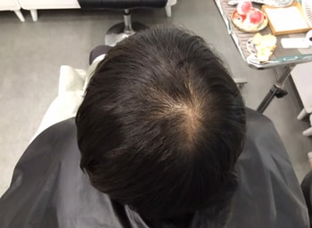 시술 전 사진. 가마쪽에 휑 하네요