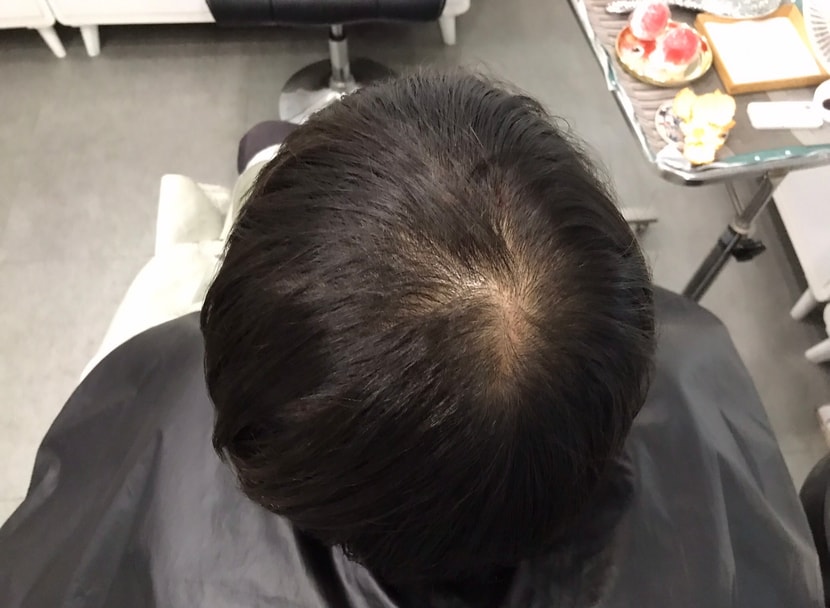 시술 전 사진. 가마쪽에 휑 하네요