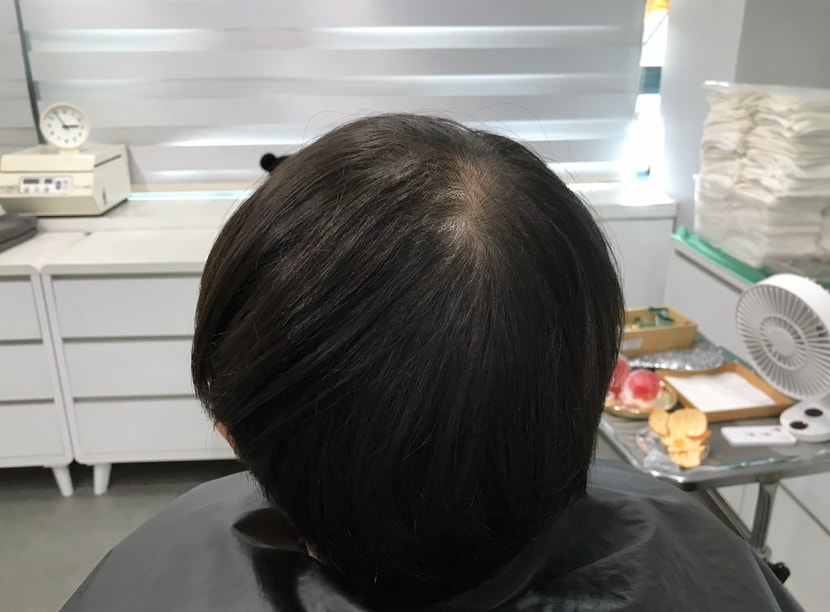 시술 전 사진입니다