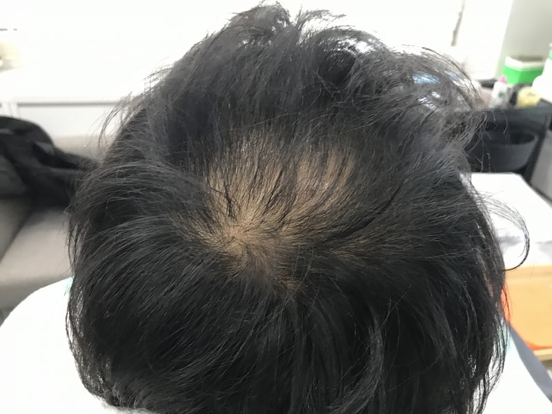 긴 고민끝에 두피문신을 하고 왔습니다.
