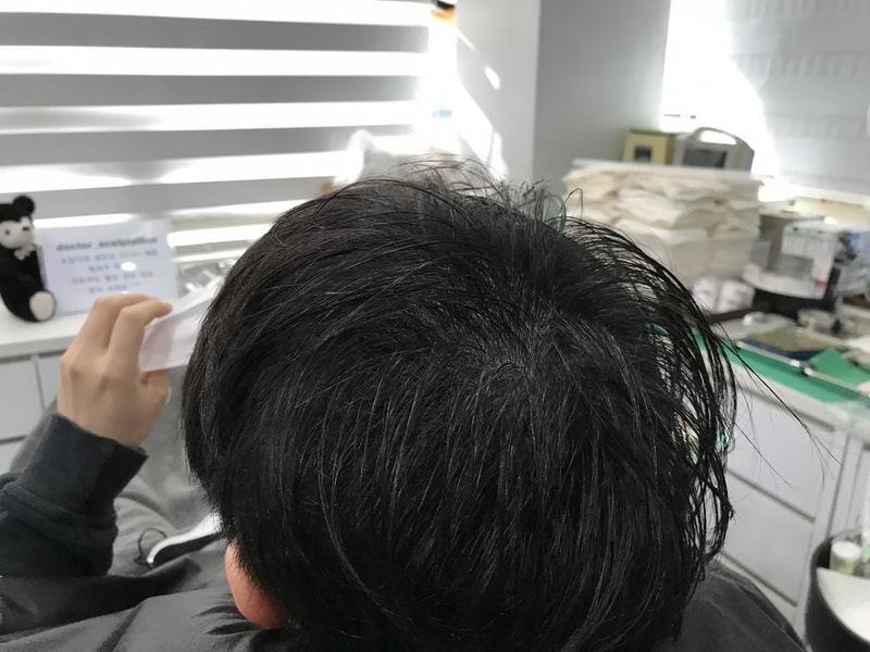 第2次修护后，一个月后